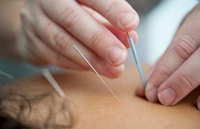 Beneficios de la Acupuntura