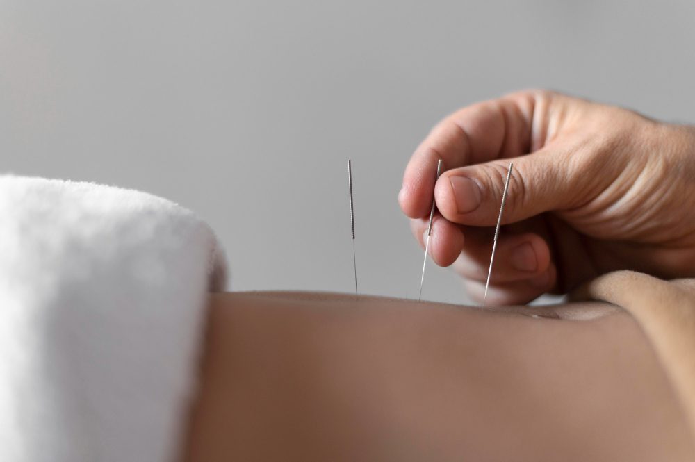 Acupuntura para la ansiedad: ¿realmente funciona?